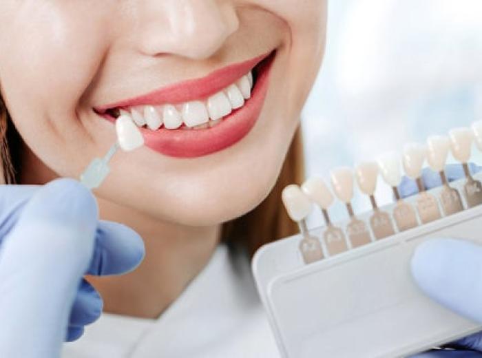 How to Choose the Right Color for Your Porcelain Veneers