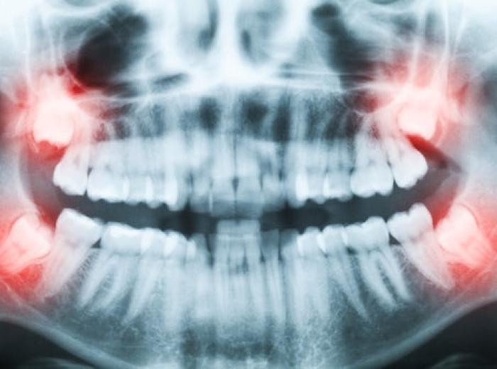 4 Things You Need to Know About Wisdom Tooth Extraction