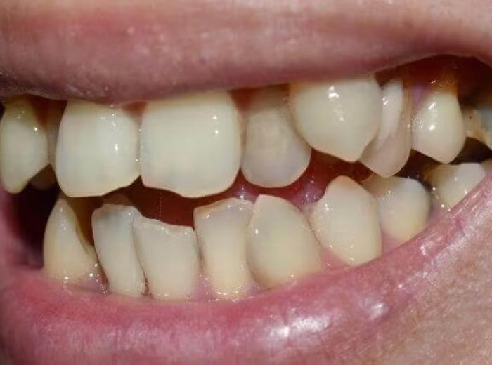 Hyperdontia: Understanding the Phenomenon of Supernumerary Teeth