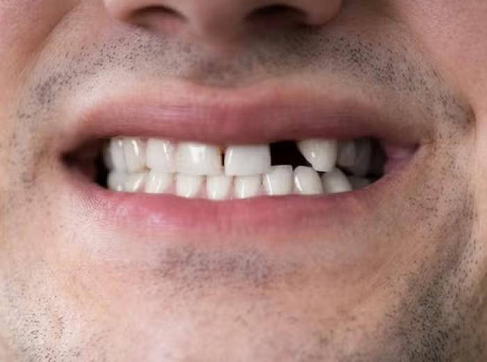 Replace That Missing Tooth with a Permanent Dental Implant